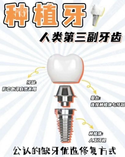 上海十院种植牙多少钱一个？口腔科团队、技术、口碑等优势介绍!真实案例曝光
