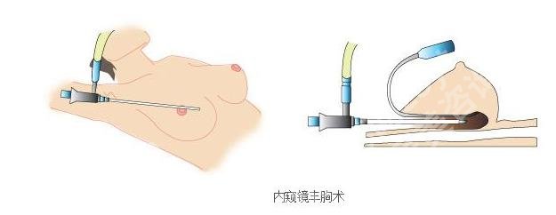 陈育哲隆胸术后图片曝光！经典案例戳进来看