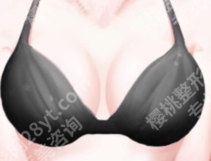 陈育哲动感隆胸多少钱？隆胸价格2万元起，更新2025费用