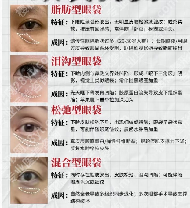 孙逸仙医院祛眼袋怎么样？真实的顾客口碑：好评连连！