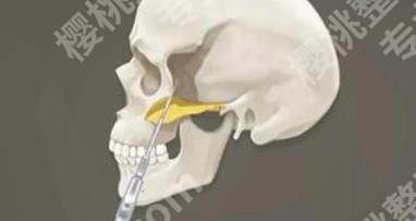 郑州颧骨颧弓矫正医院哪家好？戳进来看各医院真实的口碑点评！