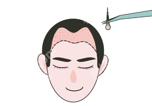 北京304医院植发怎么预约？附医院亮点及真实案例