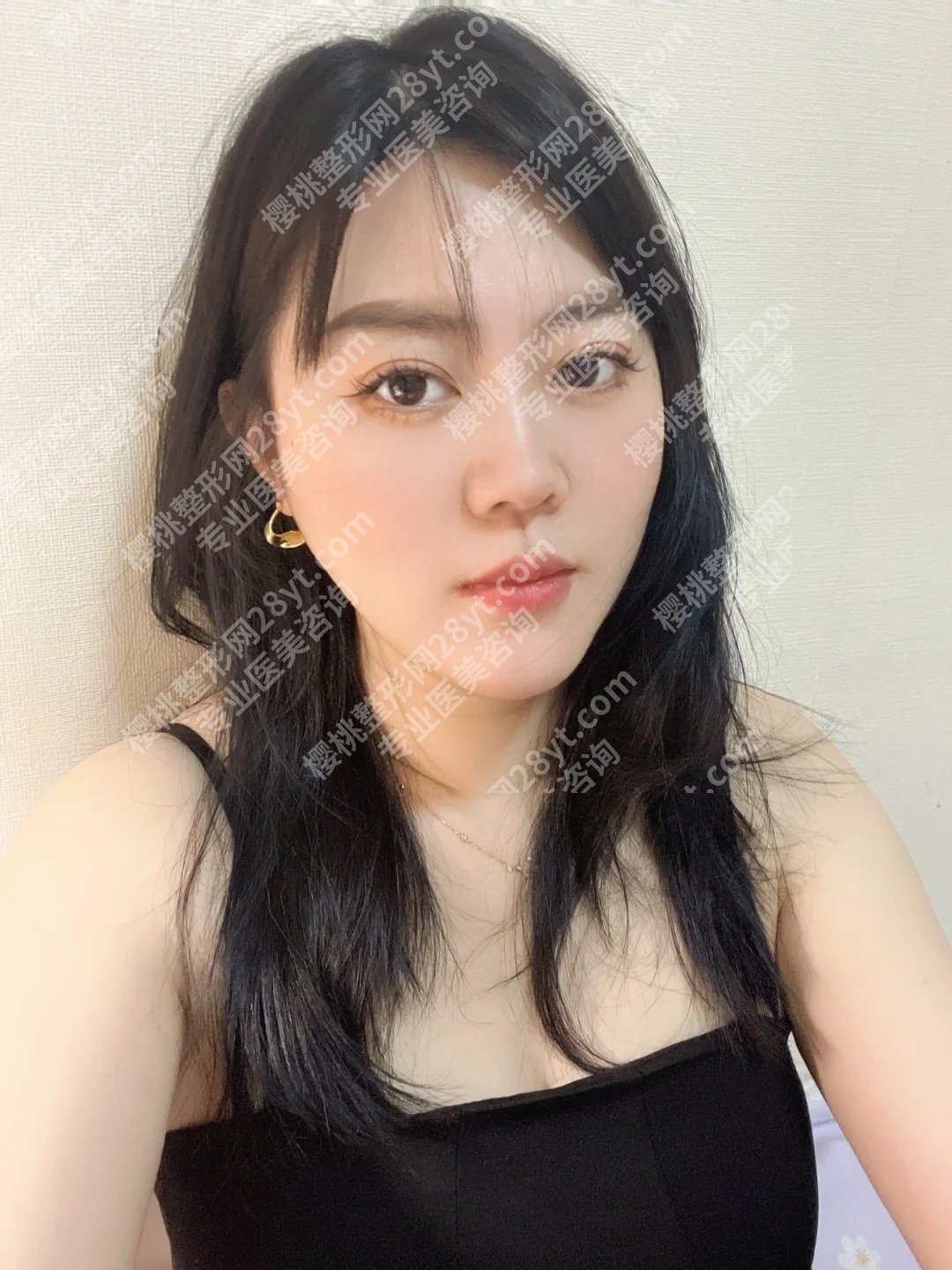 中山大学附属第三医院近视激光手术怎么样？医院亮点、案例展示、2025价格表