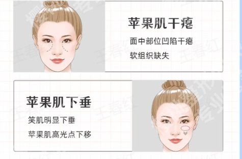 北京苹果肌复位价格2025一览+医院top名单汇总！速速收藏
