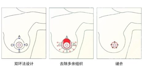 北京八大处胸部缩小手术费用贵不贵？医院简介|价目表更新！