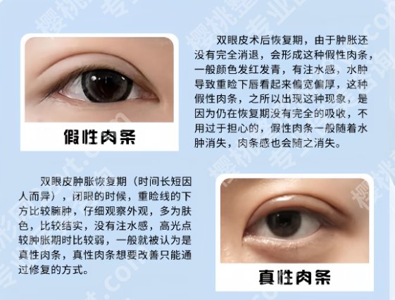 廖祥钧做双眼皮怎么样？效果怎么样？附双眼皮整形项目面诊小技巧！