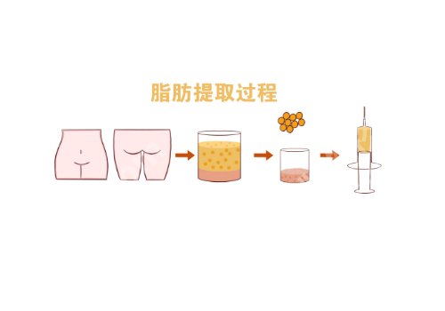2025金华中心医院脂肪填充多少钱？低至15,000元起，附医生信息