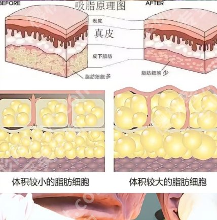 杭州腰腹部吸脂减肥价格多少？吸脂后状态可以维持多久？