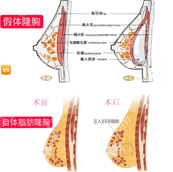 孙湄杨做隆胸怎么样？案例细节查看，在线预览2025价格表信息