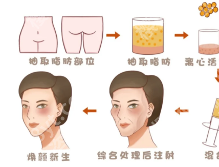 厦门自体脂肪填充好的医生有哪些？严选top级别医生简介公布