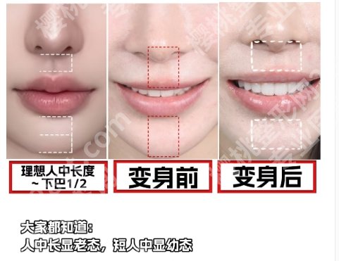 ***做人中窝好吗？医生基本介绍、真人案例图反馈！