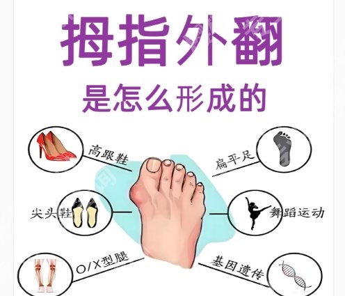 北京苏敬达拇外翻手术价格贵不贵？医生基本信息|案例展示！