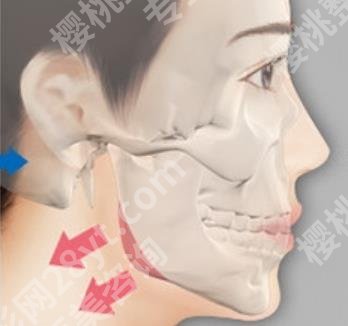 郑州磨下颌角的医院哪家做的好？各医院综合实力大比拼！