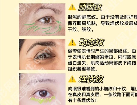 汪福强做祛眼袋怎么样？医生个人资料及面诊小技巧附上！