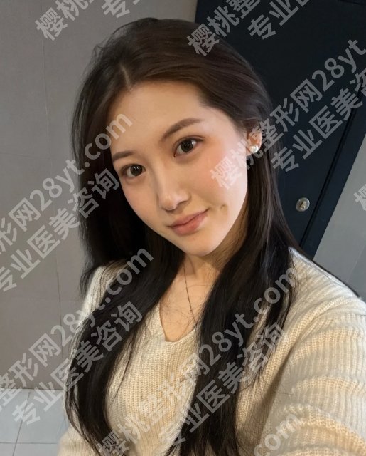 李天石医生做双眼皮案例分享！技术精湛、风格自然！