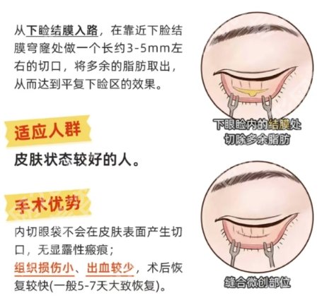 广医一院去眼袋怎么样？医院资料、明星项目、案例鉴赏！