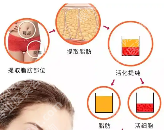 上海脂肪隆胸谢芸医生怎么样？含医生资料_坐诊医院简介公布