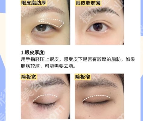 南京做双眼皮修复医生不错的都有谁？燕辛|郝超|谭谦口碑值得信赖！