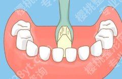 保定二院正畸费用多少？龅牙矫正11643元起