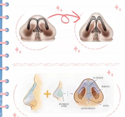 南医大友谊医院隆鼻怎么样？医院技术优势剖析！戳进来看