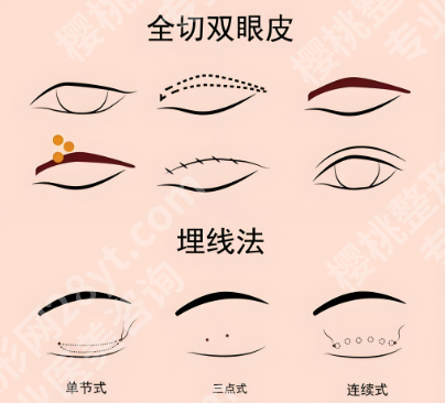 芜湖二院割双眼皮收费标准如何？术后注意事项和医院咨询盘点