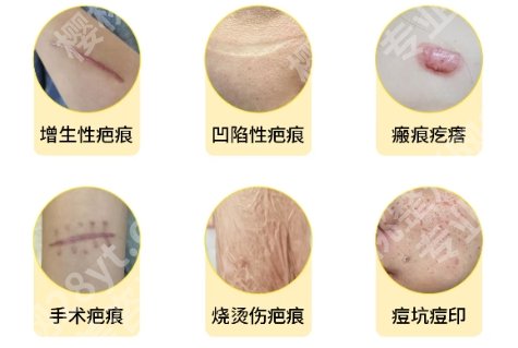 陈再洪医生疤痕切除手术案例图展示！医生概况来袭！