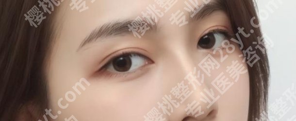 游晓波鼻子案例曝光！前、术后小贴士分享给大家！