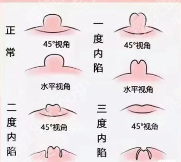 北京八大处乳头内陷手术怎么样？网友亲身经历分享！