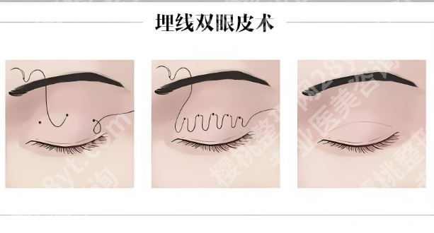 北京煤炭总医院整形科医生介绍如何？医院咨询查看，2025价格参考