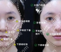 北京颧骨内推加下颌角截骨费用贵不贵？收费标准更新！