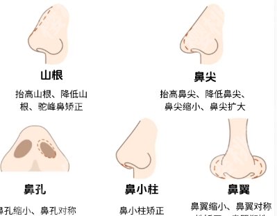 海淀医院隆鼻修复怎么样？技术好不好？案例鉴赏！