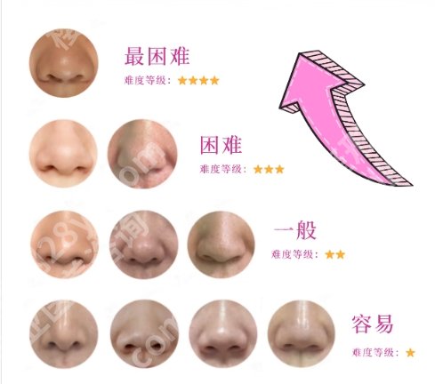 海淀医院隆鼻修复怎么样？技术好不好？案例鉴赏！