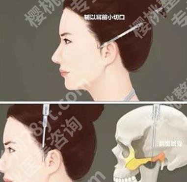 朱乐林医生学历如何？近期真人做颧骨整形案例反馈！