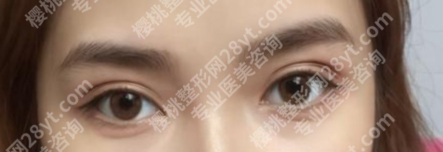 靳玉彪医生优势如何？戳进来看真人眼部手术案例！