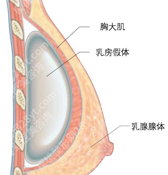 郑州芳艺乔长顺怎么样啊？胸部整形经典案例！戳进来看