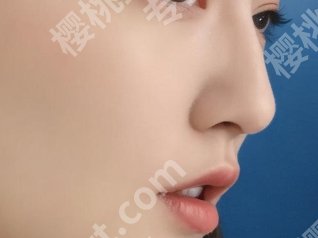 海淀医院鼻部整形怎么样？鼻部整形项目科普！有案例参考
