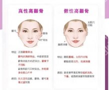 长沙颧骨内推价格贵不贵？推荐几家口碑好又实惠的医院！