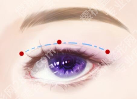 姜平医生做修复双眼皮怎么样？双眼皮技术分析，口碑查看