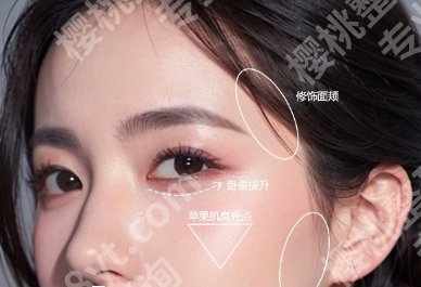 西京医院颧骨内推手术多少钱？颧骨内推手术案例分享
