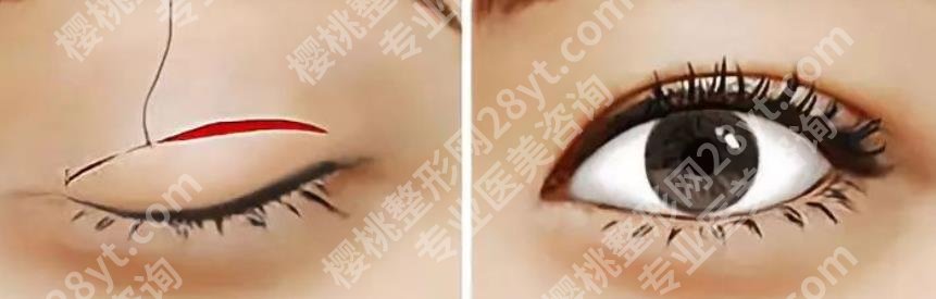 医大一院割双眼皮好吗？眼部整形术后tips介绍！