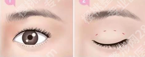 医大一院割双眼皮好吗？眼部整形术后tips介绍！
