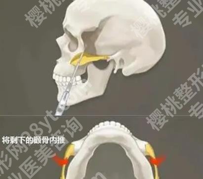 武汉颧骨整形医院排名|武汉协和、同济医院、中南医院等都是实力派！