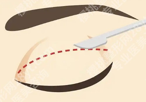 广州军美双眼皮怎么样？技术稳定！医院概况早知道！