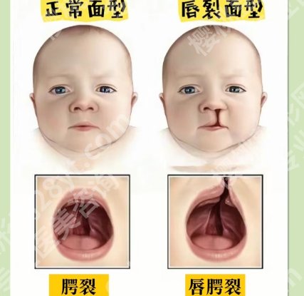 范锴医生做唇裂二次修复怎么样啊？医生口碑测评|价目表一览！