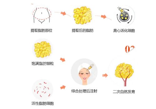 重庆华美脂肪填充哪个医生好？陶亮、陈凯、杨丽萍不容错过！