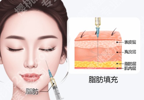 2025上海新华医院脂肪填充多少钱？低至1.4w起！再不行动就亏大了！