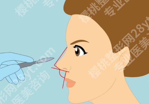 2025广州海峡假体隆鼻多少钱？价格低至1.6w起！你还在等啥？