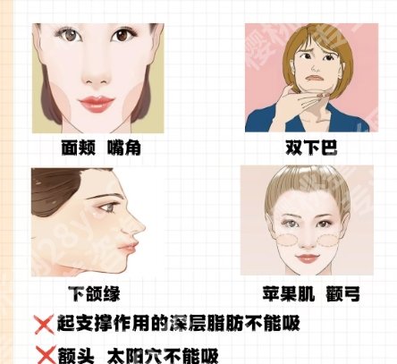 广州面部吸脂哪位医生好？2025医生排行榜名单一览！