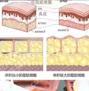 广州面部吸脂医院价格|面吸后注意事项分享！