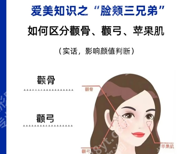 上海九院颧骨内推加下颌角一共多少钱？颧骨内推整形案例揭晓